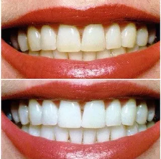 TEETH WHITENING LED AT HOME KIT